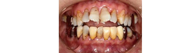 お子さまとご家族のための歯科コラム　Vol.9　「虫歯になりやすい人」がいる？